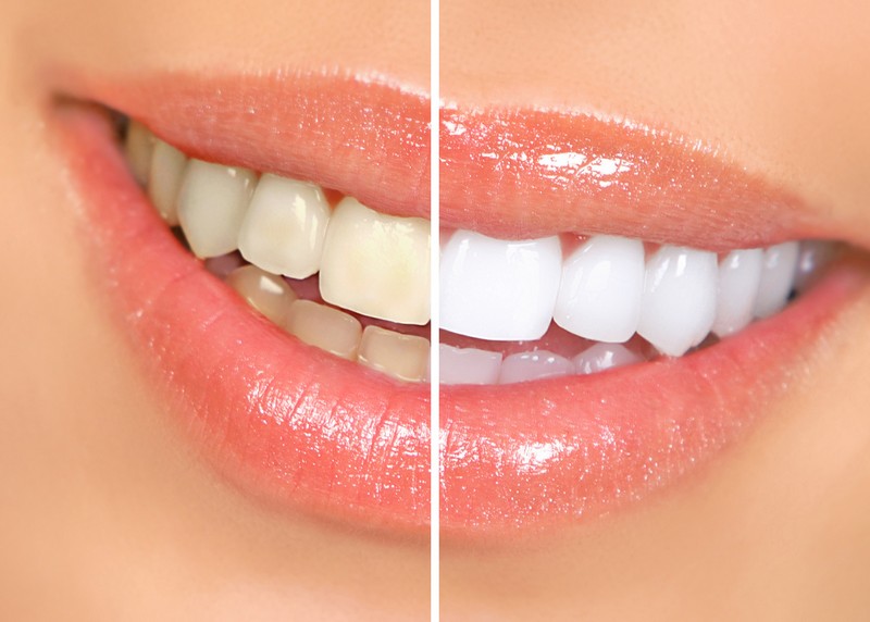 Teeth Whitening  White Plains, NY 
